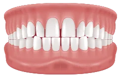 diastema